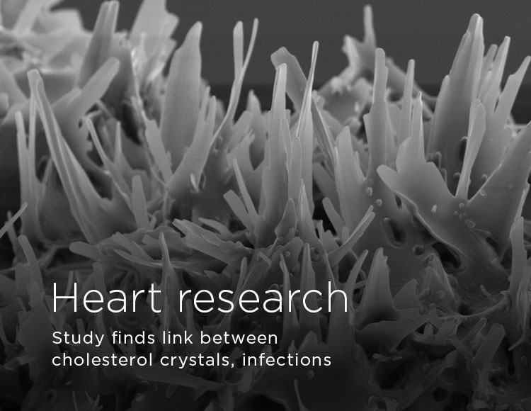 Heart research: Study finds link between cholesterol crystals, infections