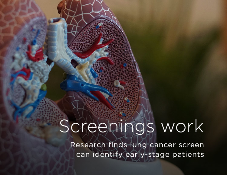 Screenings work: Research finds lung cancer screen can identify early-stage patients.